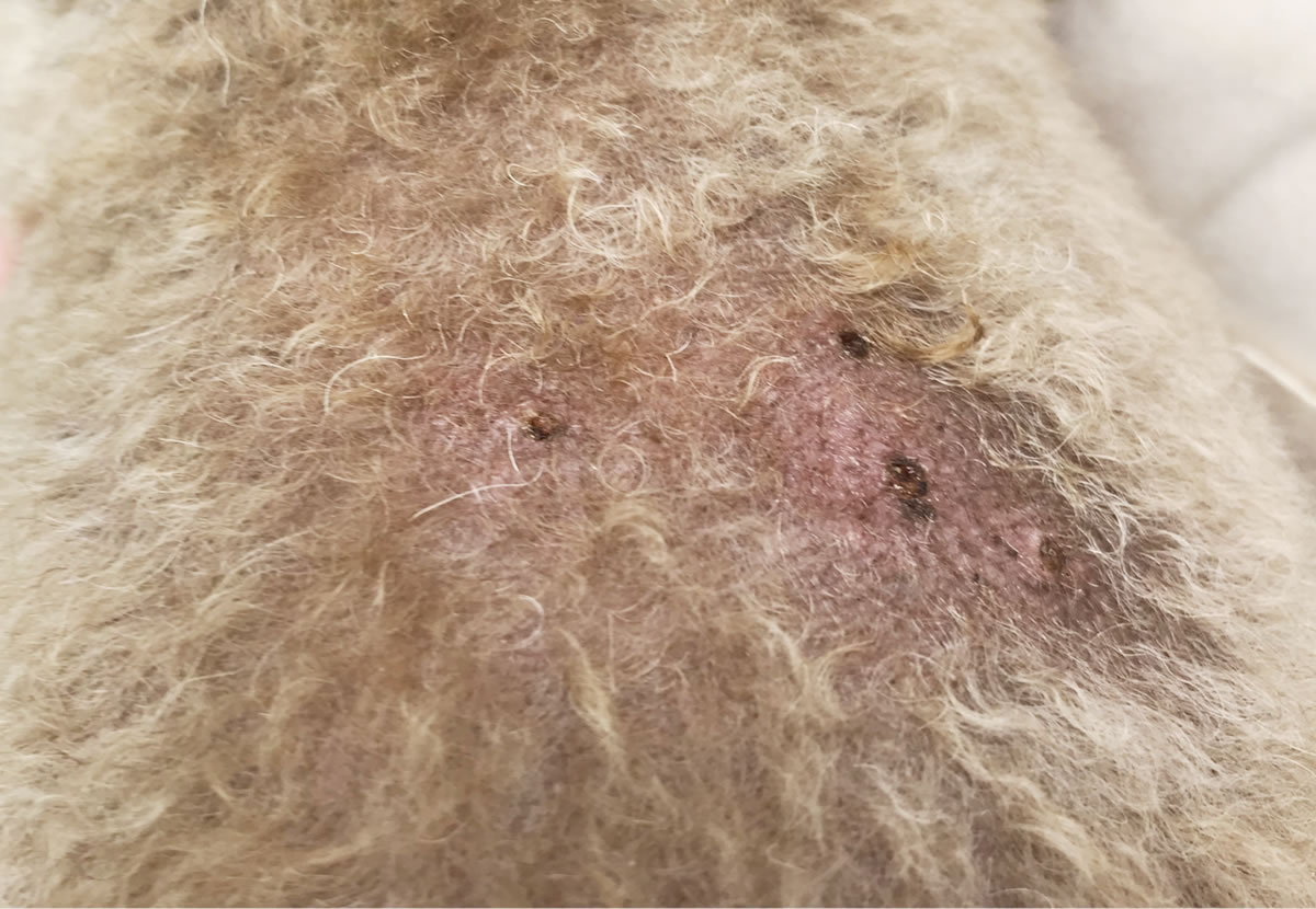 多発したイボ(良性)手術後