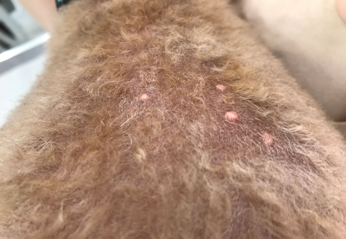 多発したイボ(良性)手術前