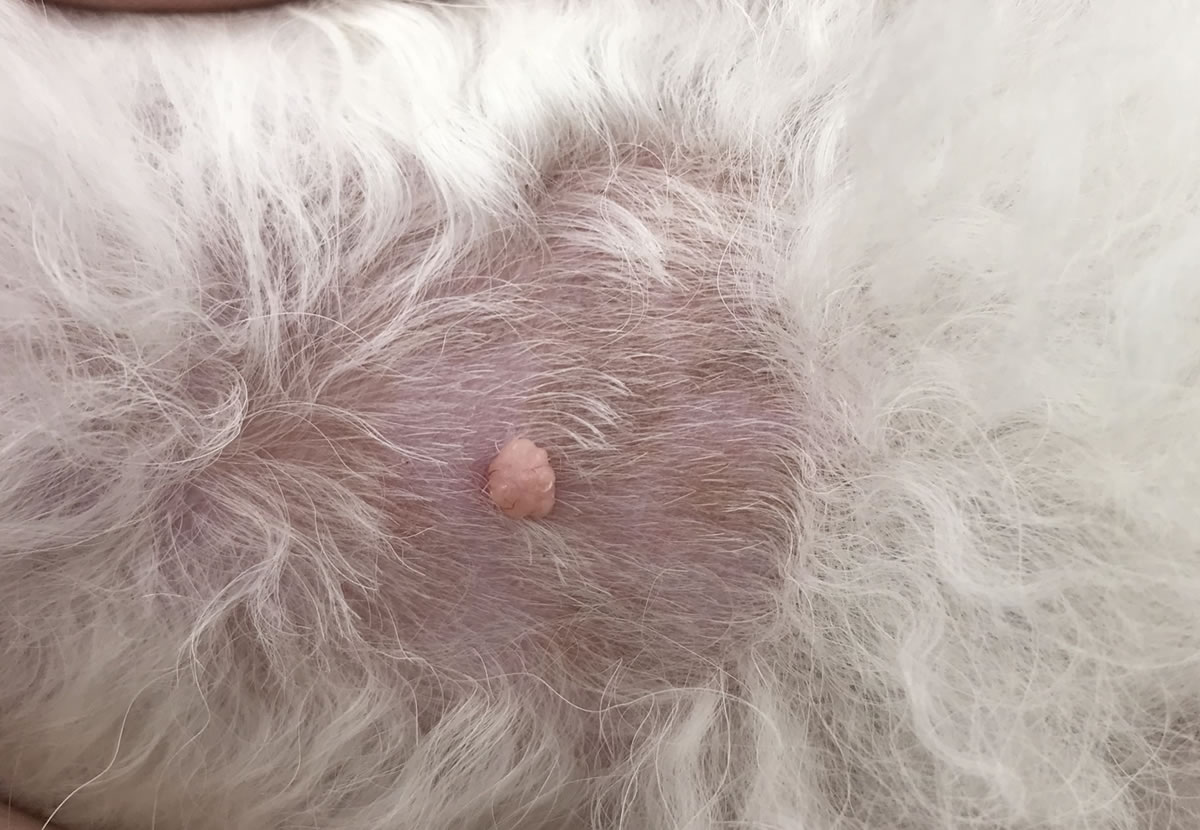 単発のイボ(良性)手術前