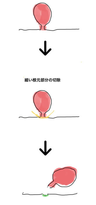 根元が細いタイプのイボ